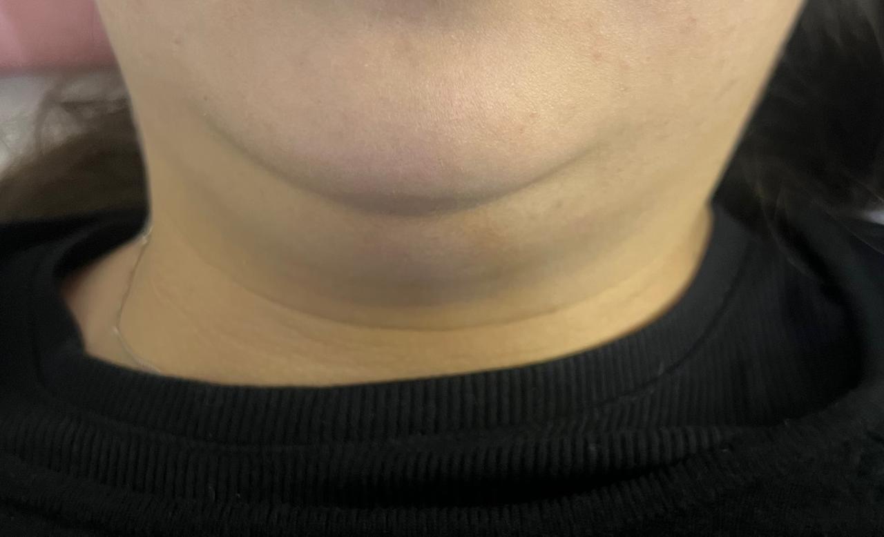 Después del tratamiento de mesoterapia para papada