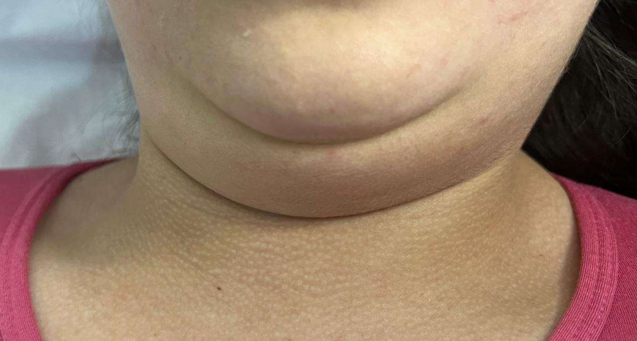 Antes del tratamiento de mesoterapia para papada